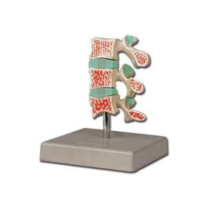MODELLO OSTEOPOROSI