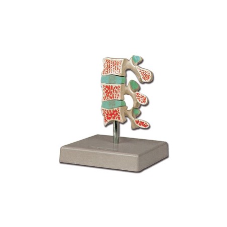 MODELLO OSTEOPOROSI