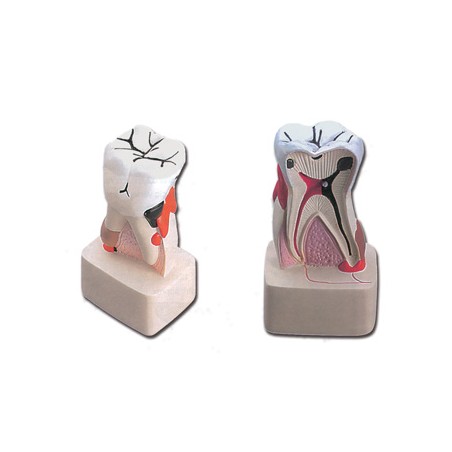 MODELLO PATOLOGIA DENTALE